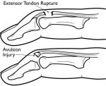 mallet-finger-tendon-rupture-injury-hand-therapy-2