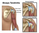 biceps-tendinitis-physiotherapy