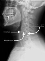 cervical-spondylosis-physiotherapy