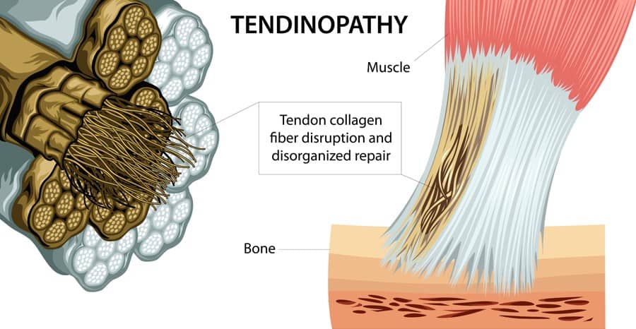 tendon-pain-tendinopathy-physiotherapy-hand-therapy
