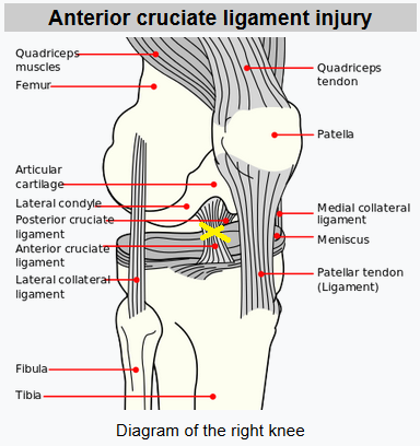 anterior-cruciate-ligament-tear-physiotherapy-3