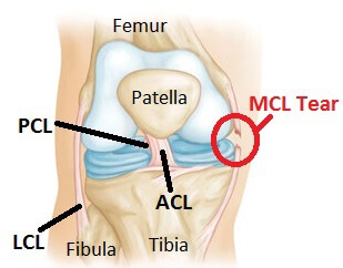 knee-medial-collateral-ligament-injury-tear-physio