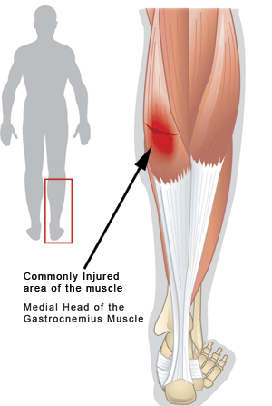 pulled-calf-muscle-physiotherapy