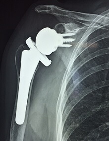 reverse-shoulder-replacement-physiotherapy