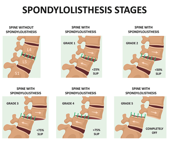 spondylolisthesis-spinal-physio